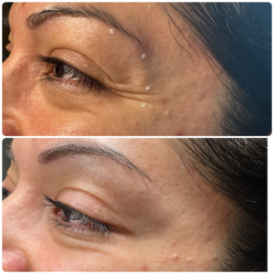 botox